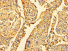 Immunohistochemistry of paraffin-embedded human cervical cancer using CSB-PA01284A0Rb at dilution of 1:100