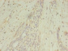 Immunohistochemistry of paraffin-embedded human breast cancer using CSB-PA013324LA01HU at dilution of 1:100