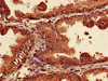 Immunohistochemistry of paraffin-embedded human prostate cancer using CSB-PA01335A0Rb at dilution of 1:100