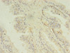 Immunohistochemistry of paraffin-embedded human prostate cancer using CSB-PA013452LA01HU at dilution of 1:100