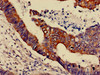IHC image of CSB-PA013456LA01HU diluted at 1:600 and staining in paraffin-embedded human colon cancer performed on a Leica BondTM system. After dewaxing and hydration, antigen retrieval was mediated by high pressure in a citrate buffer (pH 6.0) . Section was blocked with 10% normal goat serum 30min at RT. Then primary antibody (1% BSA) was incubated at 4°C overnight. The primary is detected by a biotinylated secondary antibody and visualized using an HRP conjugated SP system.