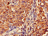 Immunohistochemistry of paraffin-embedded human lung cancer using CSB-PA013506LA01HU at dilution of 1:100