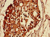 Immunohistochemistry of paraffin-embedded human breast cancer using CSB-PA013506LA01HU at dilution of 1:100