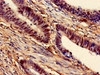 Immunohistochemistry of paraffin-embedded human colon cancer using CSB-PA013517LA01HU at dilution of 1:100