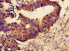 Immunohistochemistry of paraffin-embedded human colon cancer using CSB-PA01374A0Rb at dilution of 1:100