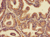 Immunohistochemistry of paraffin-embedded human prostate cancer using CSB-PA01374A0Rb at dilution of 1:100