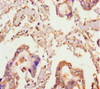Immunohistochemistry of paraffin-embedded human pancreatic cancer using CSB-PA013808LA01HU at dilution of 1:100