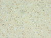 Immunohistochemistry of paraffin-embedded human liver cancer using CSB-PA014836LA01HU at dilution of 1:100