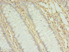 Immunohistochemistry of paraffin-embedded human colon cancer using CSB-PA014836LA01HU at dilution of 1:100