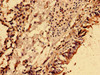 Immunohistochemistry analysis of human lung cancer using CSB-PA015891LA01HU at dilution of 1:100