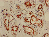 IHC image of CSB-PA015921HA01HU diluted at 1:800 and staining in paraffin-embedded human breast cancer performed on a Leica BondTM system. After dewaxing and hydration, antigen retrieval was mediated by high pressure in a citrate buffer (pH 6.0) . Section was blocked with 10% normal goat serum 30min at RT. Then primary antibody (1% BSA) was incubated at 4°C overnight. The primary is detected by a biotinylated secondary antibody and visualized using an HRP conjugated SP system.