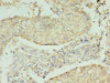 Immunohistochemistry of paraffin-embedded human lung cancer using CSB-PA016078LA01HU at dilution of 1:100
