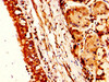 IHC image of CSB-PA016136HA01HU diluted at 1:300 and staining in paraffin-embedded human lung cancer performed on a Leica BondTM system. After dewaxing and hydration, antigen retrieval was mediated by high pressure in a citrate buffer (pH 6.0) . Section was blocked with 10% normal goat serum 30min at RT. Then primary antibody (1% BSA) was incubated at 4°C overnight. The primary is detected by a biotinylated secondary antibody and visualized using an HRP conjugated SP system.