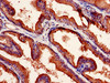 Immunohistochemistry of paraffin-embedded human prostate cancer using CSB-PA016223LA01HU at dilution of 1:100