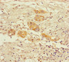 Immunohistochemistry of paraffin-embedded human pancreatic cancer using CSB-PA016307LA01HU at dilution of 1:100