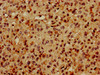 IHC image of CSB-PA01694A0Rb diluted at 1:600 and staining in paraffin-embedded human glioma performed on a Leica BondTM system. After dewaxing and hydration, antigen retrieval was mediated by high pressure in a citrate buffer (pH 6.0) . Section was blocked with 10% normal goat serum 30min at RT. Then primary antibody (1% BSA) was incubated at 4°C overnight. The primary is detected by a biotinylated secondary antibody and visualized using an HRP conjugated SP system.