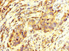 IHC image of CSB-PA017299LA01HU diluted at 1:250 and staining in paraffin-embedded human pancreatic cancer performed on a Leica BondTM system. After dewaxing and hydration, antigen retrieval was mediated by high pressure in a citrate buffer (pH 6.0) . Section was blocked with 10% normal goat serum 30min at RT. Then primary antibody (1% BSA) was incubated at 4°C overnight. The primary is detected by a biotinylated secondary antibody and visualized using an HRP conjugated SP system.