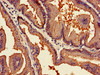Immunohistochemistry of paraffin-embedded human prostate cancer using CSB-PA017456LA01HU at dilution of 1:100