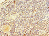Immunohistochemistry of paraffin-embedded human lung cancer using CSB-PA017489HA01HU at dilution of 1:100