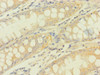 Immunohistochemistry of paraffin-embedded human colon cancer using CSB-PA017715LA01HU at dilution of 1:100
