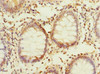 Immunohistochemistry of paraffin-embedded human colon cancer using CSB-PA018416LA01HU at dilution of 1:100