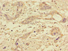 Immunohistochemistry of paraffin-embedded human pancreatic cancer using CSB-PA018505LA01HU at dilution of 1:100