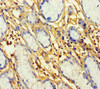 Immunohistochemistry of paraffin-embedded human gastric cancer using CSB-PA018748LA01HU at dilution of 1:100