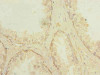 Immunohistochemistry of paraffin-embedded human prostate cancer using CSB-PA018755LA01HU at dilution of 1:100