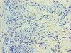 Immunohistochemistry of paraffin-embedded human breast cancer using CSB-PA019153HA01HU at dilution of 1:100