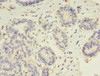 Immunohistochemistry of paraffin-embedded human breast cancer using CSB-PA019253EA01HU at dilution of 1:100