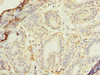 Immunohistochemistry of paraffin-embedded human breast cancer using CSB-PA019260LA01HU at dilution of 1:100