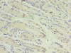 Immunohistochemistry of paraffin-embedded human gastric cancer using CSB-PA019311LA01HU at dilution of 1:100