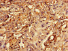 Immunohistochemistry of paraffin-embedded human lung cancer using CSB-PA019504LA01HU at dilution of 1:100