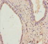 Immunohistochemistry of paraffin-embedded human prostate cancer using CSB-PA019523LA01HU at dilution of 1:100