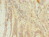 Immunohistochemistry of paraffin-embedded human colon cancer using CSB-PA019659LA01HU at dilution of 1:100