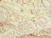 Immunohistochemistry of paraffin-embedded human breast cancer using CSB-PA019687LA01HU at dilution of 1:100