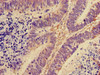 Immunohistochemistry of paraffin-embedded human ovarian cancer using CSB-PA020217ED01HU at dilution of 1:100