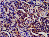 IHC image of CSB-PA020641HA01HU diluted at 1:200 and staining in paraffin-embedded human lung cancer performed on a Leica BondTM system. After dewaxing and hydration, antigen retrieval was mediated by high pressure in a citrate buffer (pH 6.0) . Section was blocked with 10% normal goat serum 30min at RT. Then primary antibody (1% BSA) was incubated at 4°C overnight. The primary is detected by a biotinylated secondary antibody and visualized using an HRP conjugated SP system.