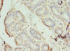 Immunohistochemistry of paraffin-embedded human breast cancer using CSB-PA020650LA01HU at dilution of 1:100