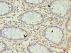 Immunohistochemistry of paraffin-embedded human colon cancer using CSB-PA020931LA01HU at dilution of 1:100