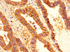IHC image of CSB-PA021065LA01HU diluted at 1:200 and staining in paraffin-embedded human colon cancer performed on a Leica BondTM system. After dewaxing and hydration, antigen retrieval was mediated by high pressure in a citrate buffer (pH 6.0) . Section was blocked with 10% normal goat serum 30min at RT. Then primary antibody (1% BSA) was incubated at 4°C overnight. The primary is detected by a biotinylated secondary antibody and visualized using an HRP conjugated SP system.