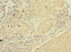 Immunohistochemistry of paraffin-embedded human lung cancer using CSB-PA021174LA01HU at dilution of 1:100