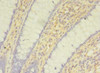 Immunohistochemistry of paraffin-embedded human colon cancer using CSB-PA021867LA01HU at dilution of 1:100