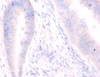 Immunohistochemistry of paraffin-embedded human colon cancer using CSB-PA022902DA01HU at dilution of 1:100