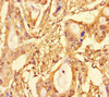 Immunohistochemistry of paraffin-embedded human pancreatic cancer using CSB-PA022956LA01HU at dilution of 1:100