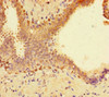 Immunohistochemistry of paraffin-embedded human prostate cancer using CSB-PA022956LA01HU at dilution of 1:100