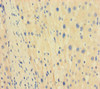Immunohistochemistry of paraffin-embedded human liver cancer using CSB-PA023240LA01HU at dilution of 1:100