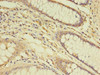 Immunohistochemistry of paraffin-embedded human colon cancer using CSB-PA023510LA01HU at dilution of 1:100