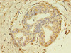 Immunohistochemistry of paraffin-embedded human breast cancer using CSB-PA023510LA01HU at dilution of 1:100