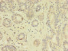 Immunohistochemistry of paraffin-embedded human breast cancer using CSB-PA023577HA01HU at dilution of 1:100